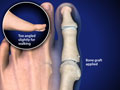 Arthroscopic Surgery | Instability Repairs | Herrin, IL | Carbondale, IL | Harrisburg, IL | Paducah, KY