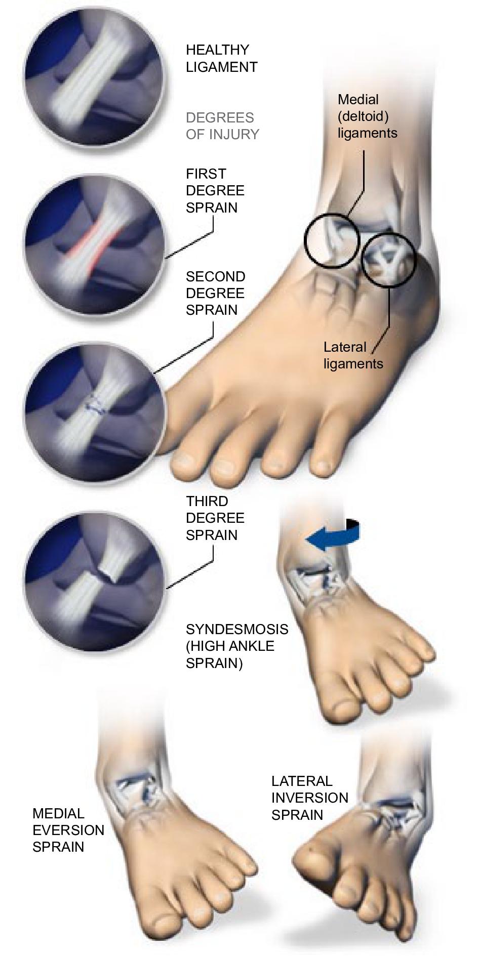 How To Rehab a High Ankle Sprain