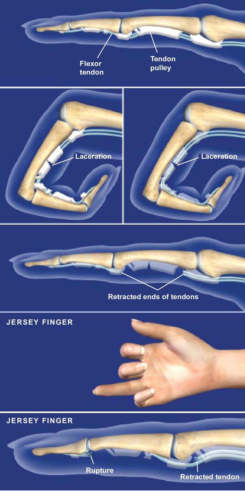 cuenta Espantar suave How Do I Know if I Have a Flexor Tendon Injury? - Orthopaedic Associates of  Riverside