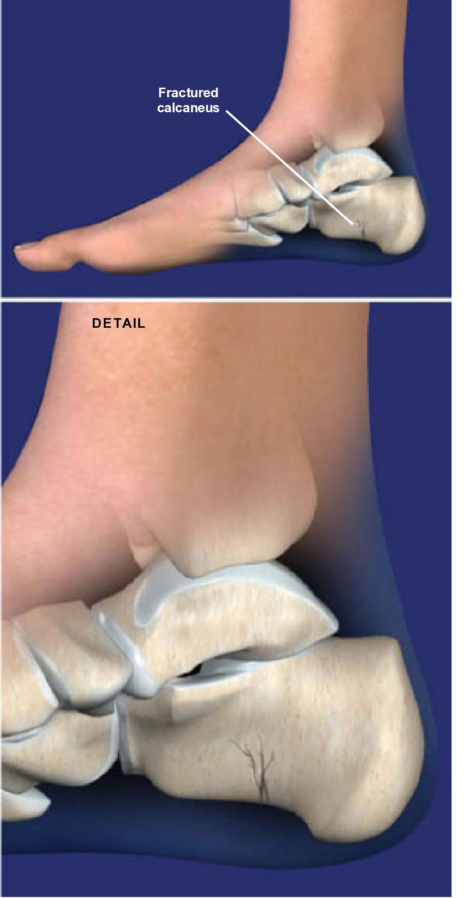 Fracture of the Heel Bone (Calcaneus) Orthopaedic Associates of Riverside