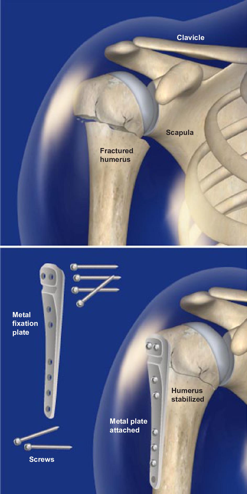 Orif Surgery For Proximal Humerus Fracture Orthopaedic Associates Of