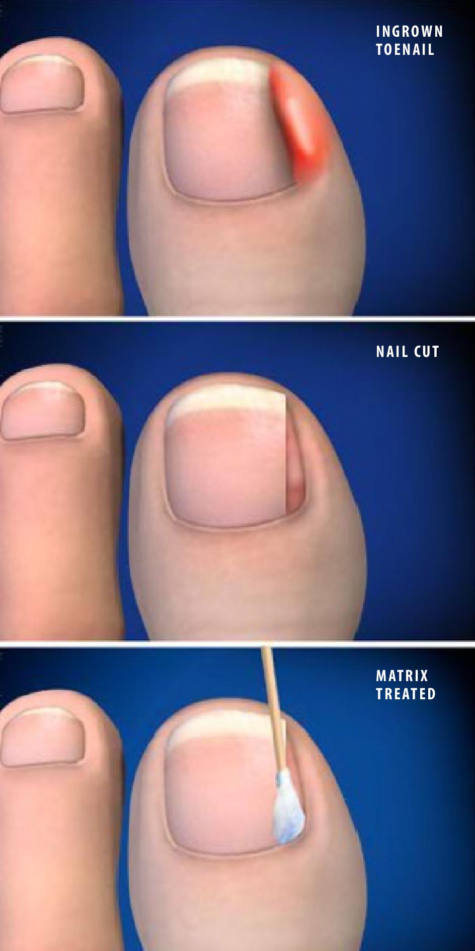Partial Nail Removal (Matrixectomy) - Orthopaedic Associates of Riverside