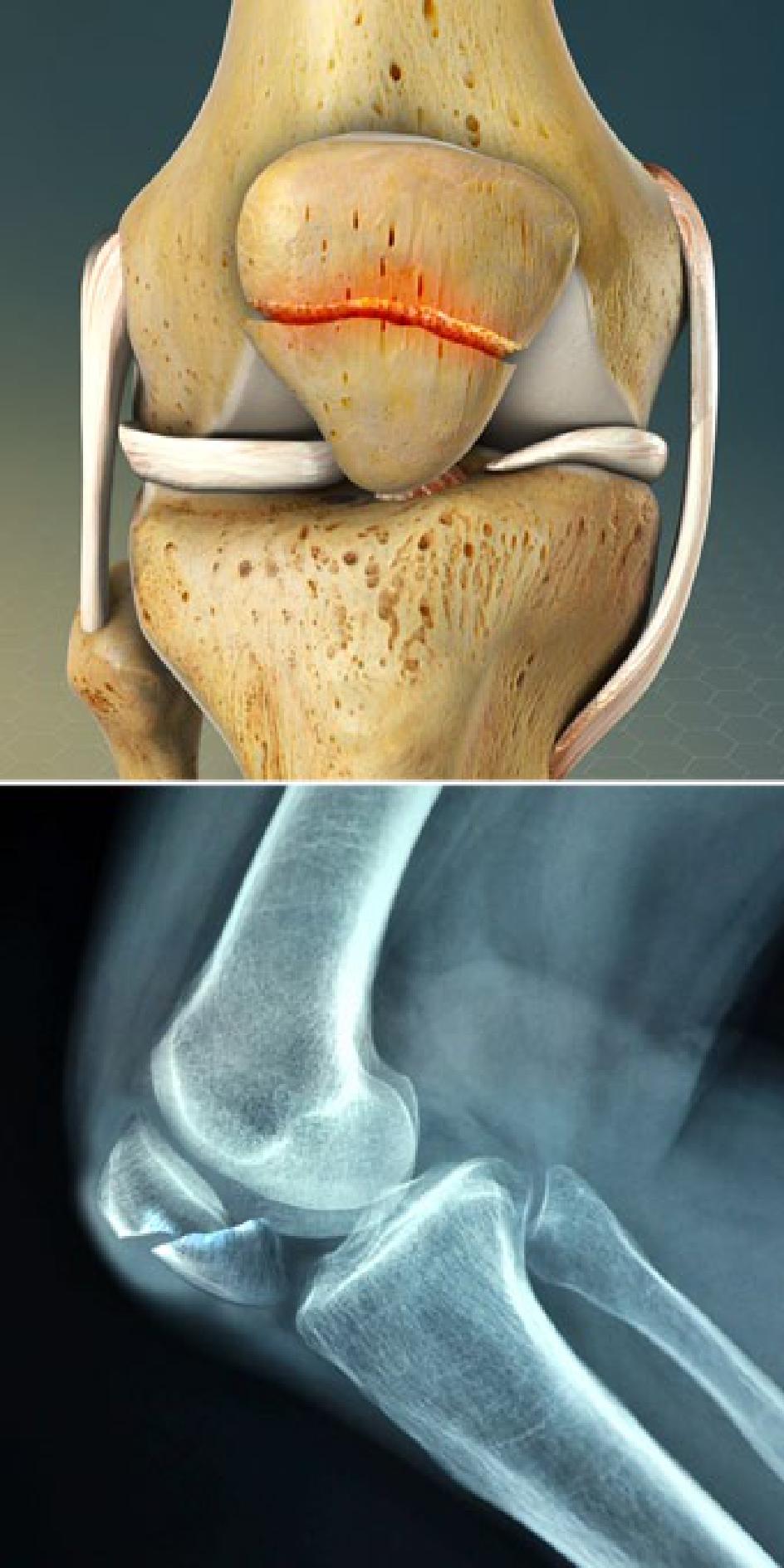Best Fractured Patella Knee Brace by a Knee Specialist