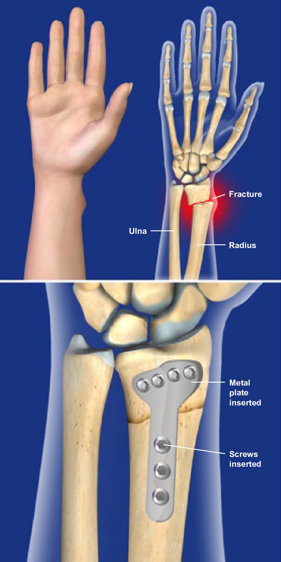 radial and ulnar torus fracture