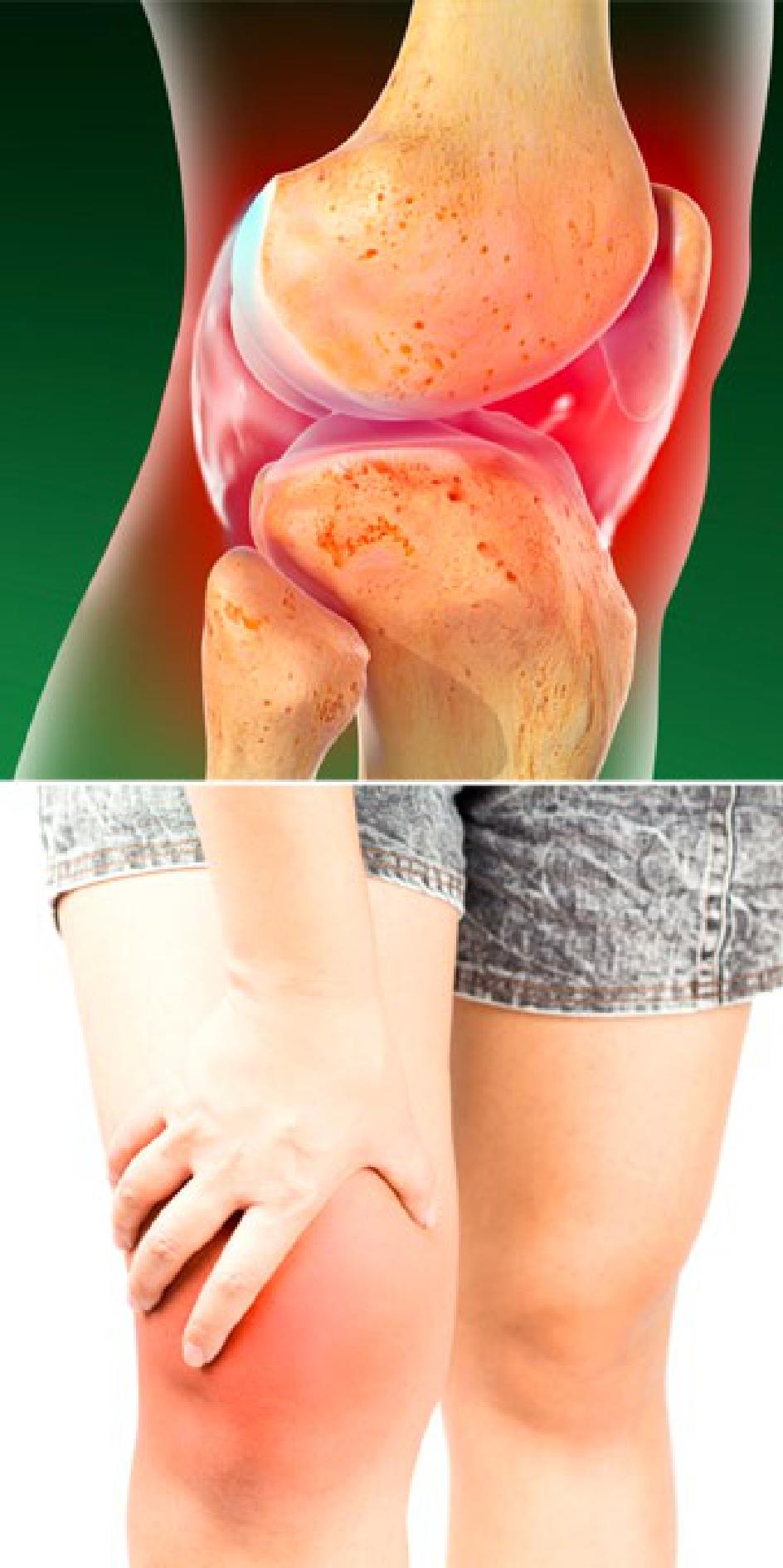 Arthritis adalah septic Salmonella Septicemia
