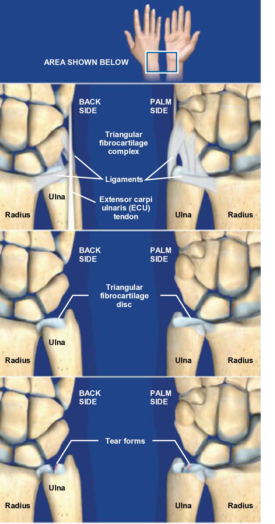 Monograph leje Orientalsk Triangular Fibrocartilage Complex (TFCC) Tears - Orthoriverside.com