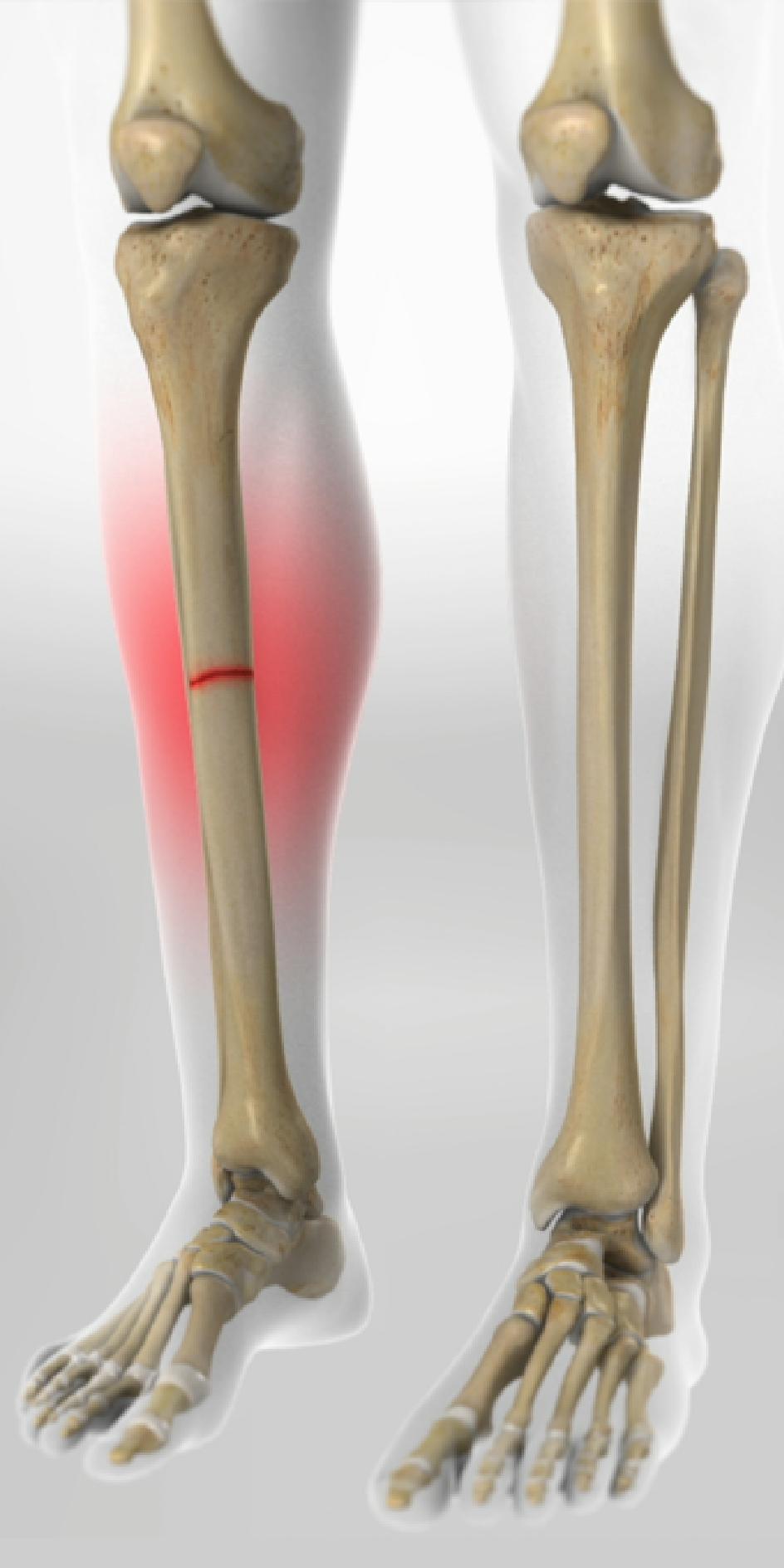 tibial stress fracture