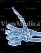 Hand, thumbs up (skeletal, palmar view, x-ray)