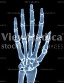 Hand (skeletal, palmar view, raised, x-ray)