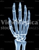 Hand (skeletal, dorsal view, raised, x-ray)