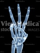 Hand, counting three (skeletal, palmar view, x-ray)