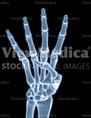 Hand, counting four (skeletal, palmar view, x-ray)