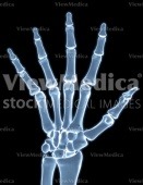 Hand, counting five (skeletal, palmar view, x-ray)